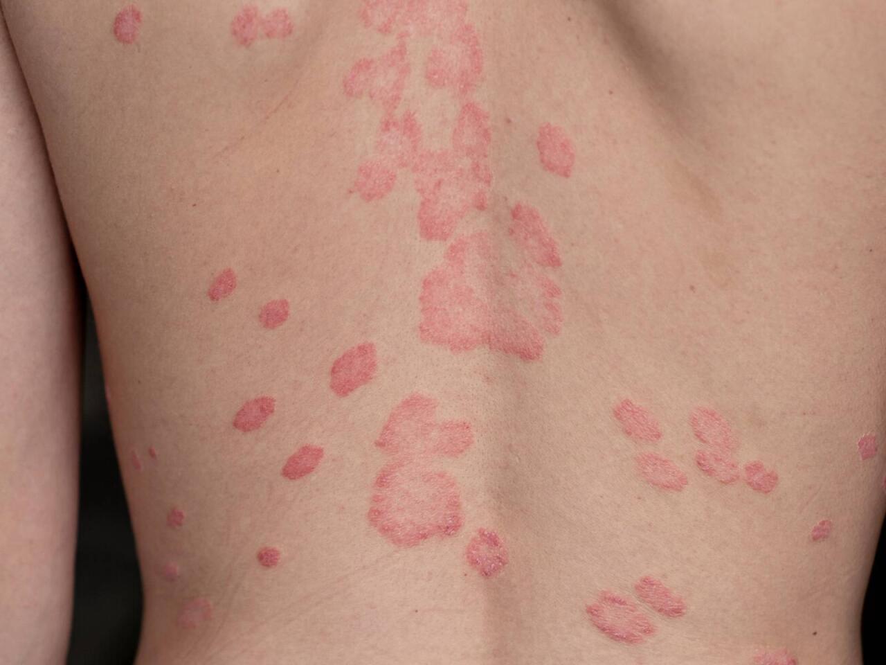 Beldəki səpkilərin yaranma səbəbi a&ccedil;ıqlandı