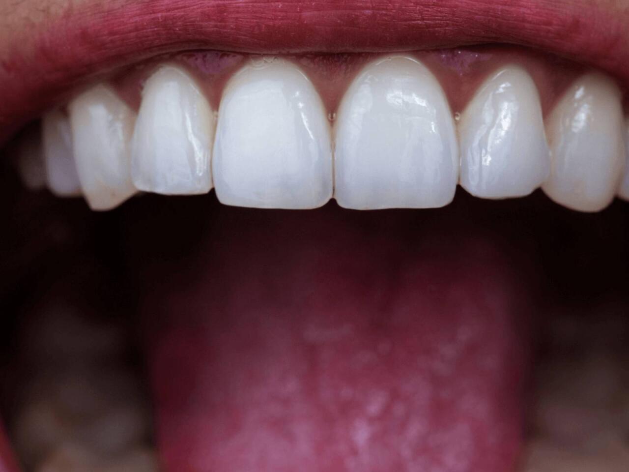 Dişlərin gizli d&uuml;şməni a&ccedil;ıqlandı