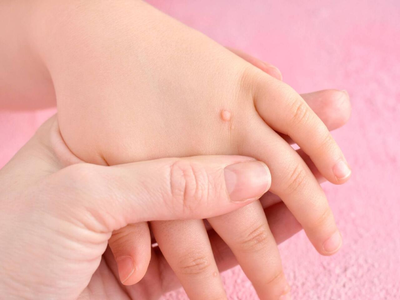 Sarımsaq əzməsini ziyilin &uuml;st&uuml;nə vurun  Yox edəcək