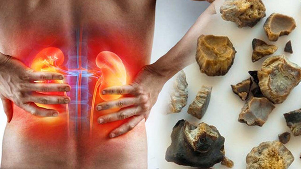 Alimlər böyrək daşlarına yeni çarə TAPDI