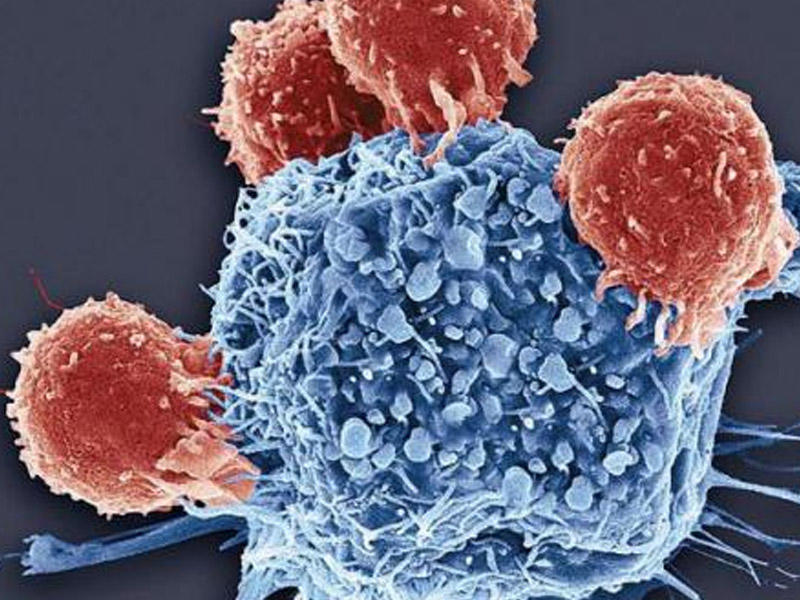 Alimlər xərçəngin ən ölümcül növlərindən birinə səbəb olan vərdişi açıqlayıb