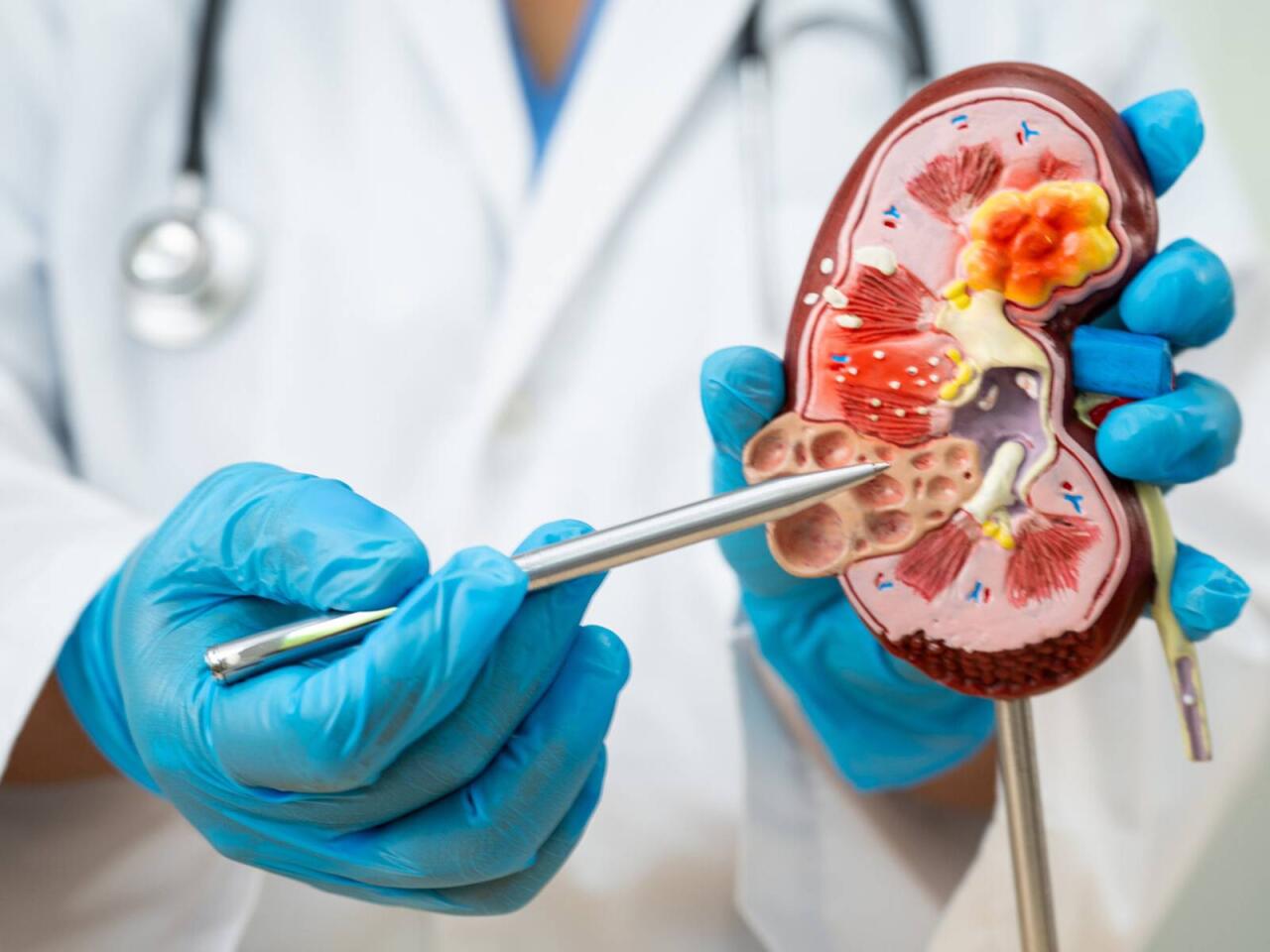 B&ouml;yrək daşlarının yaranmasına səbəb olan qidalar a&ccedil;ıqlandı