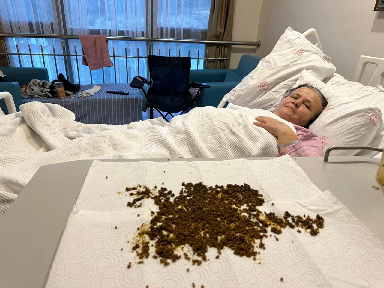 Qarın ağrısından şikayət etdi, &ouml;d&uuml;ndən 20 mindən &ccedil;ox daş &ccedil;ıxdı 