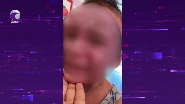 Bakıda bağçada uşaq xəsarət alıb, təcili yardım çağırılmayıb