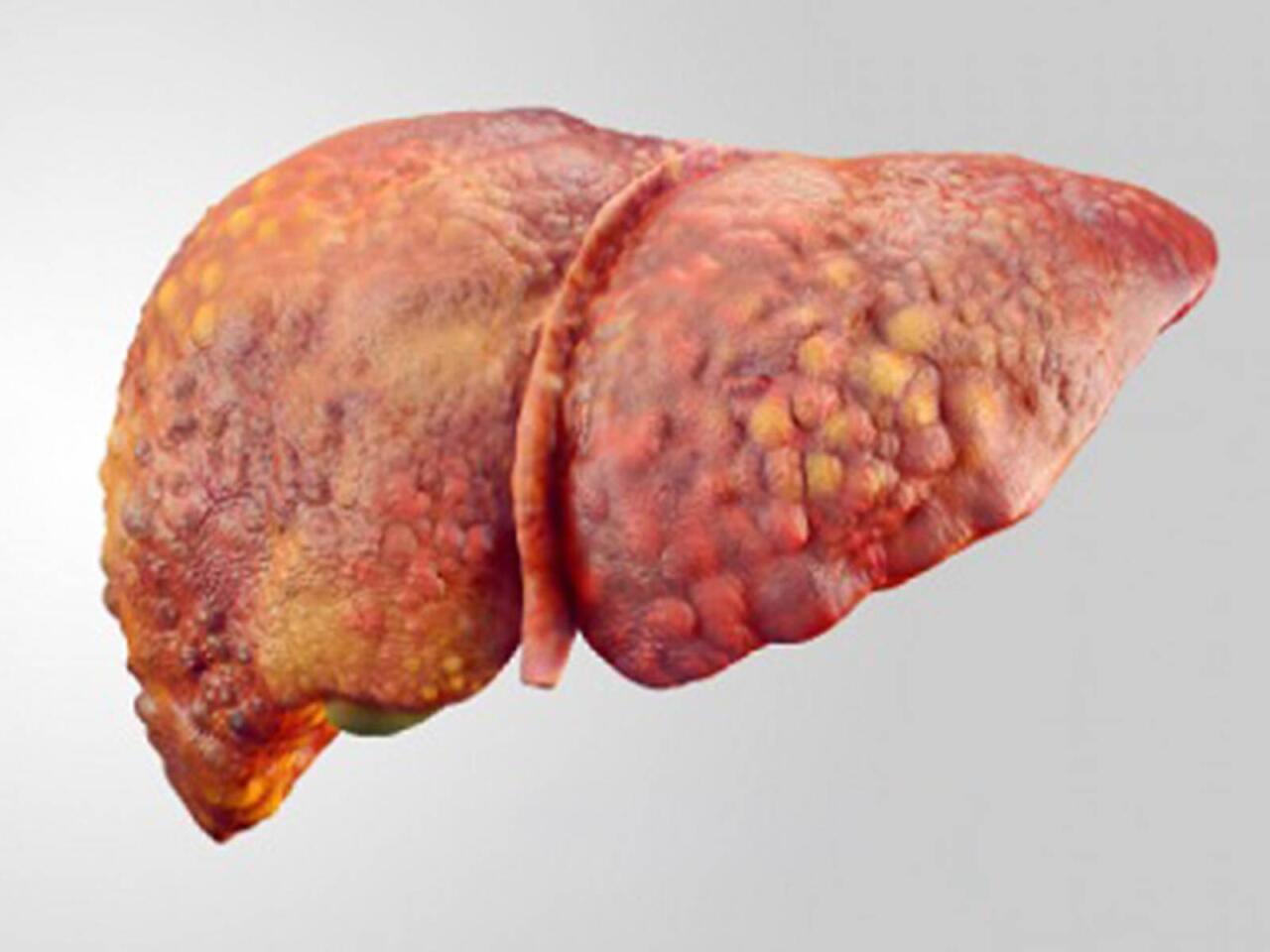 Qaraciyər yağlanıbsa &ouml;l&uuml;m riski 35 dəfə artır