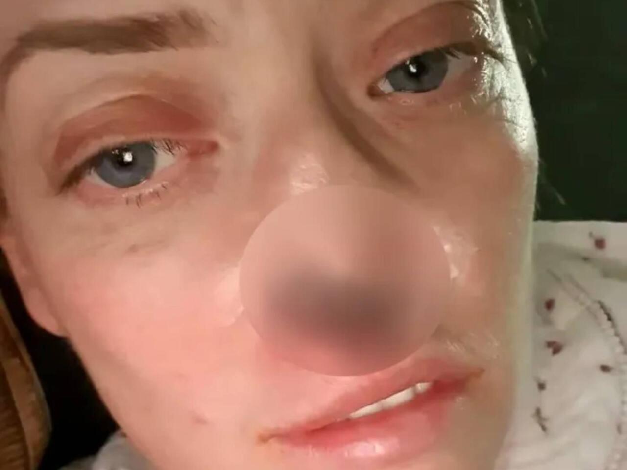 T&uuml;rkiyədə implant etdirən qadının burnu &ccedil;&uuml;r&uuml;məyə başladı  VİDEO