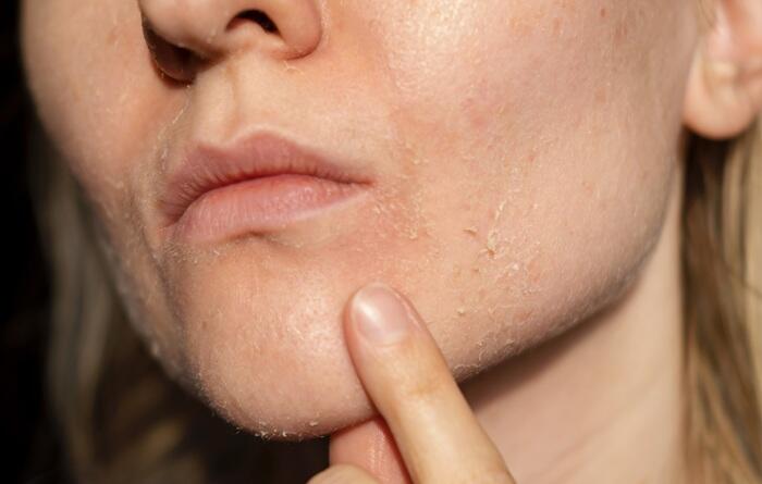 Soyuq havada quru dəri problemindən necə xilas olaq?