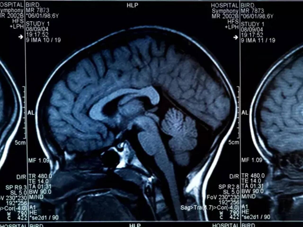 Beyni məhv edən qidalar a&ccedil;ıqlandı  Hər g&uuml;n yeyirik