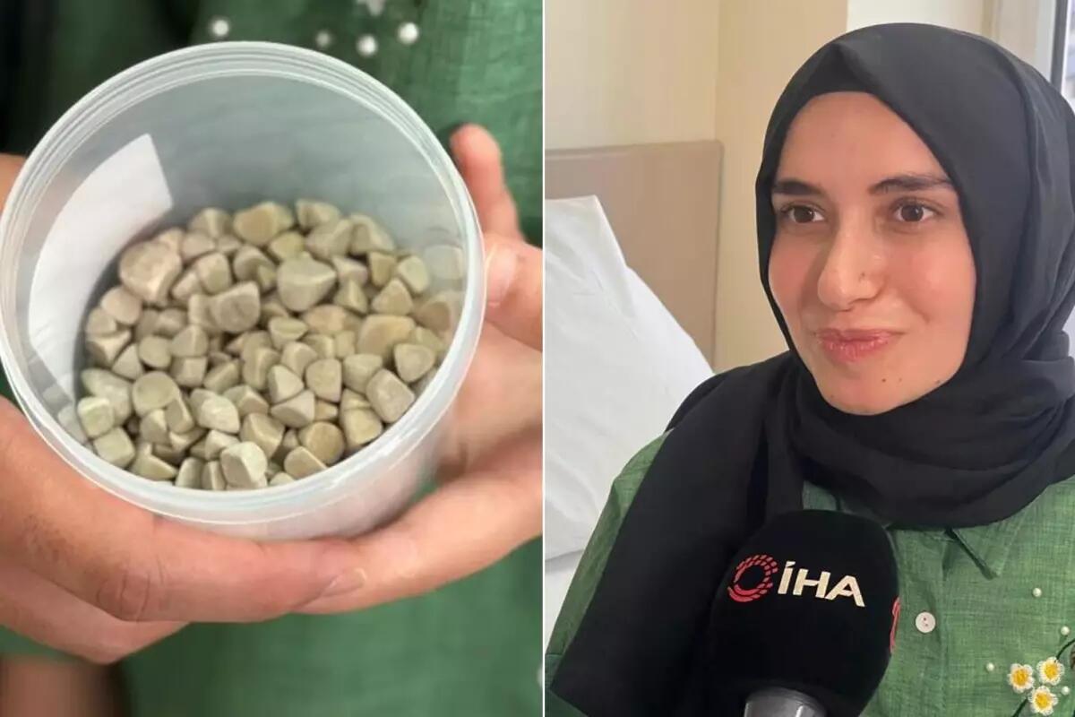 21 yaşlı Fatmanın bədənindən 287 daş &ccedil;ıxarıldı &ndash; tibb aləmi şokda 