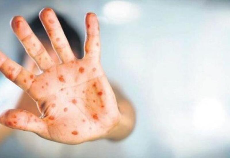 SanktPeterburqda iki nəfərdə meymun&ccedil;i&ccedil;əyi virusu aşkarlanıb