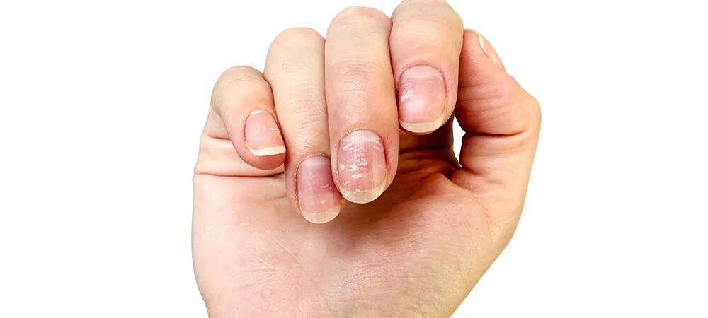 &Ccedil;inko &ccedil;atışmazlığı nələrə səbəb olur  problemi aradan qaldırmağın