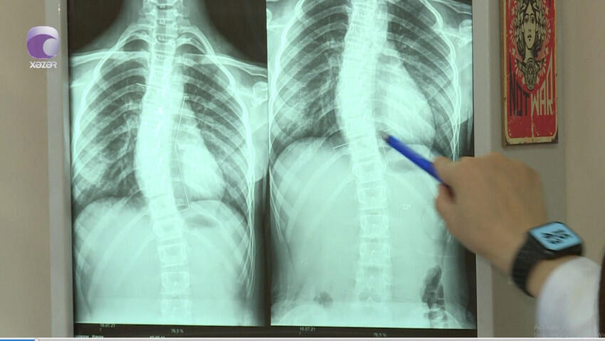 Son zamanlar &ldquo;812&rdquo; yaş arası uşaqlarda bel və boyun ağrılarının səbəbi