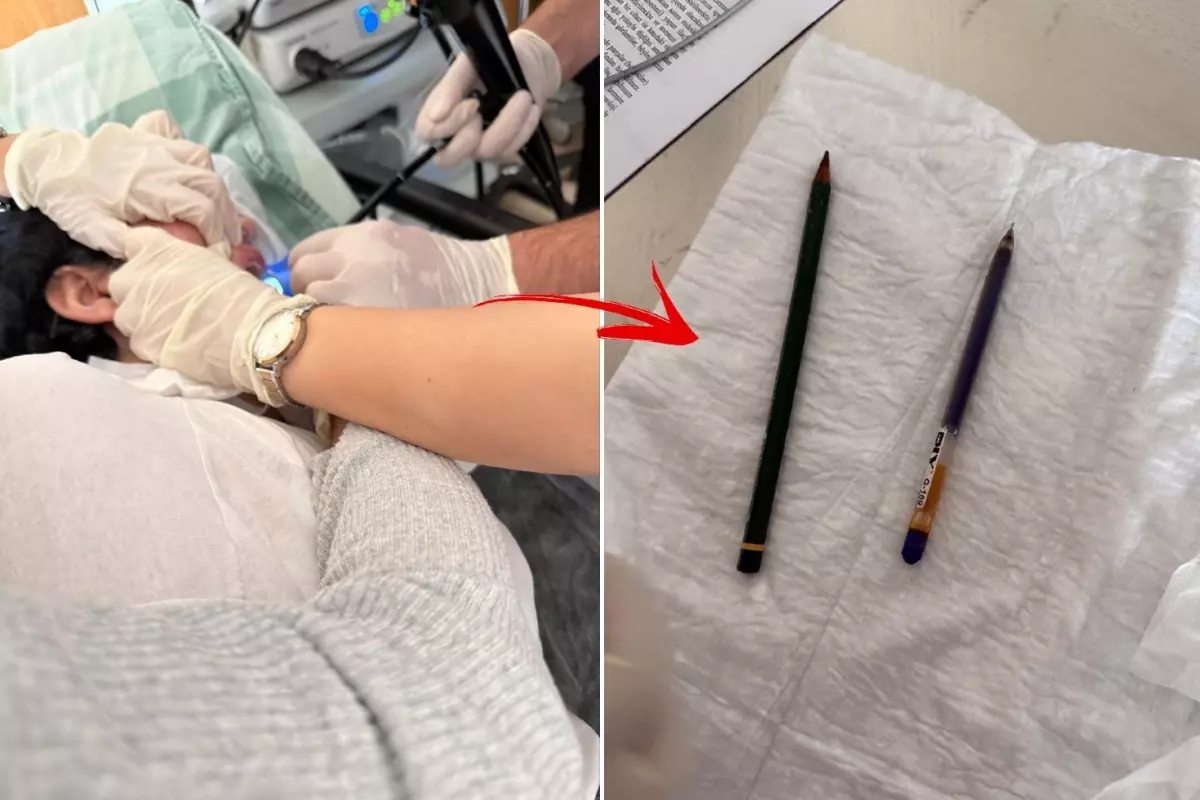 22 yaşlı qadının mədəsindən qələm &ccedil;ıxdı 