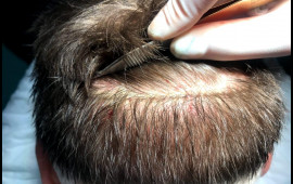 47 yaşlı kişi sa&ccedil; əkimi zamanı &ouml;ld&uuml;