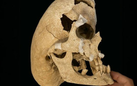 600 illik cəngavərdə nadir "Kruzon" sindromu aşkar edildi