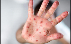 Azərbaycanda qızılca və suçiçəyi ilə bağlı epidemioloji vəziyyət necədir?