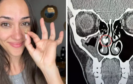 Qadının burnundan g&ouml;r&uuml;n nə &ccedil;ıxdı  35 ildir belə yaşayıbmış...