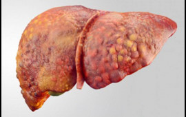 Qaraciyər yağlanıbsa &ouml;l&uuml;m riski 35 dəfə artır