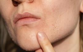 Soyuq havada quru dəri problemindən necə xilas olaq?