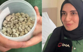 21 yaşlı Fatmanın bədənindən 287 daş çıxarıldı – tibb aləmi şokda